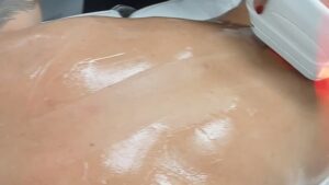 foto de laser shr indoloro barato en estepona