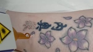 foto de eliminación de tatuajes rápido y efectivo